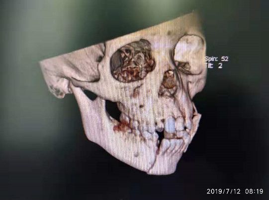 因这个动作,广西一8岁小男孩面部严重撕裂,暑假期间安全不容忽视