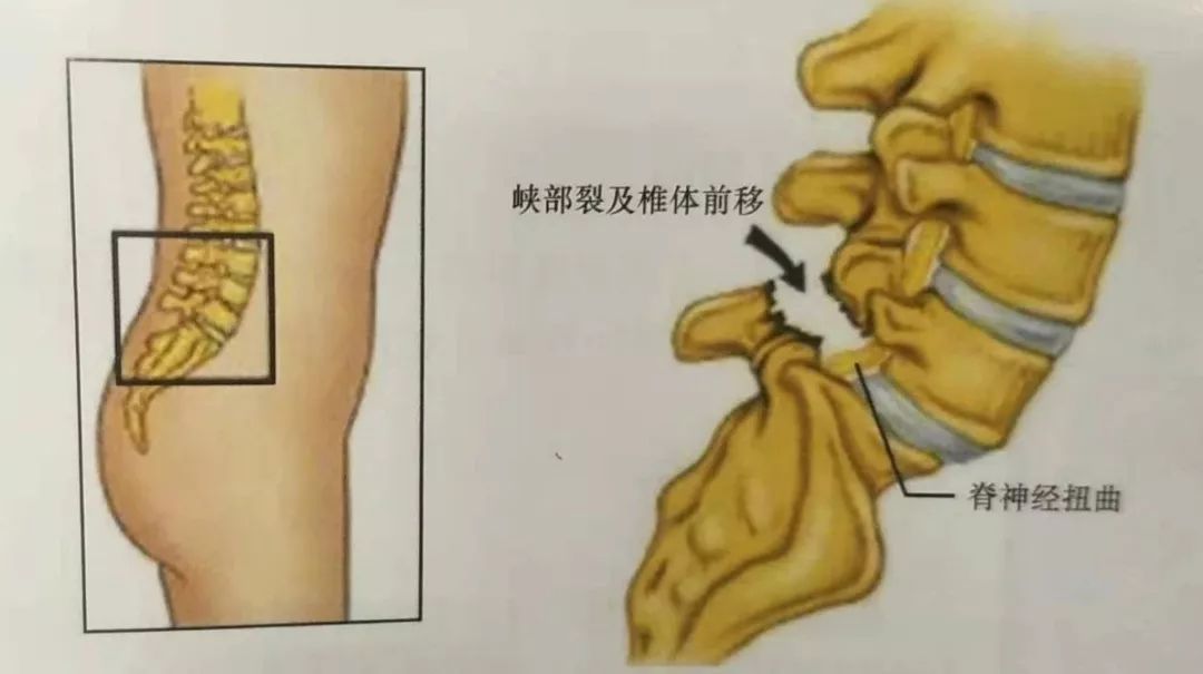 腰椎滑脱是怎么造成的图片