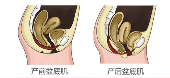 你不瞭解的產後修復之盆底肌的秘密還不趕快收藏