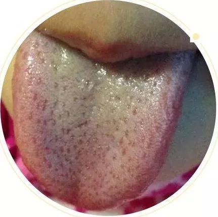 谈谈六种特殊舌象_笔者