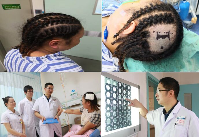 据彭伟介绍,通过设计特殊"发型"保留头发为患者实施开颅手术这是第一