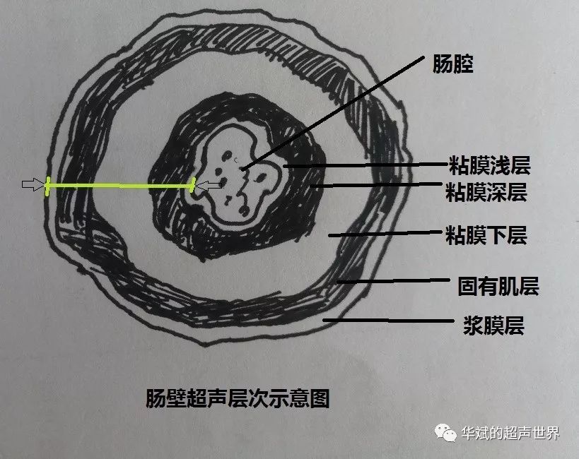 兒科超聲正常值五腸壁厚度修正版兼更正一個流傳甚廣的錯誤