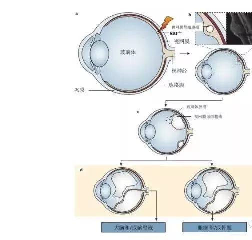 視網膜母細胞瘤是咋回事?