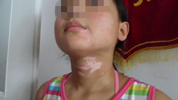 13岁女孩患白癜风,却是这2个原因引起的,家长需谨慎