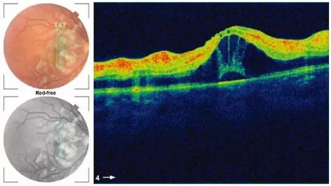譜域光學相干斷層掃描(sp-oct)顯示,神經視網膜脫離黃斑和視網膜水腫