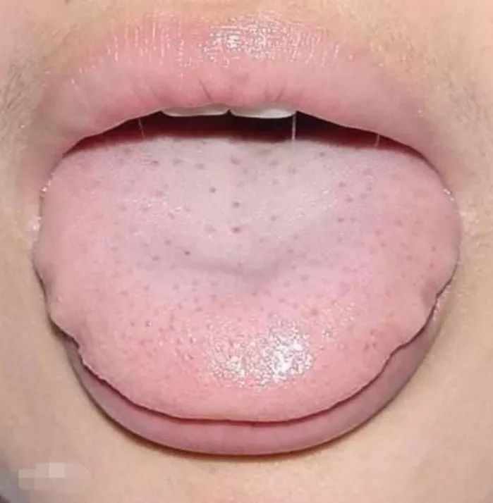 谈谈六种特殊舌象