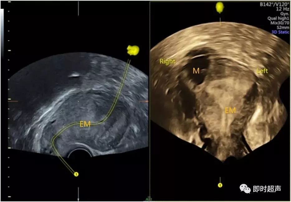 输卵管间质部妊娠