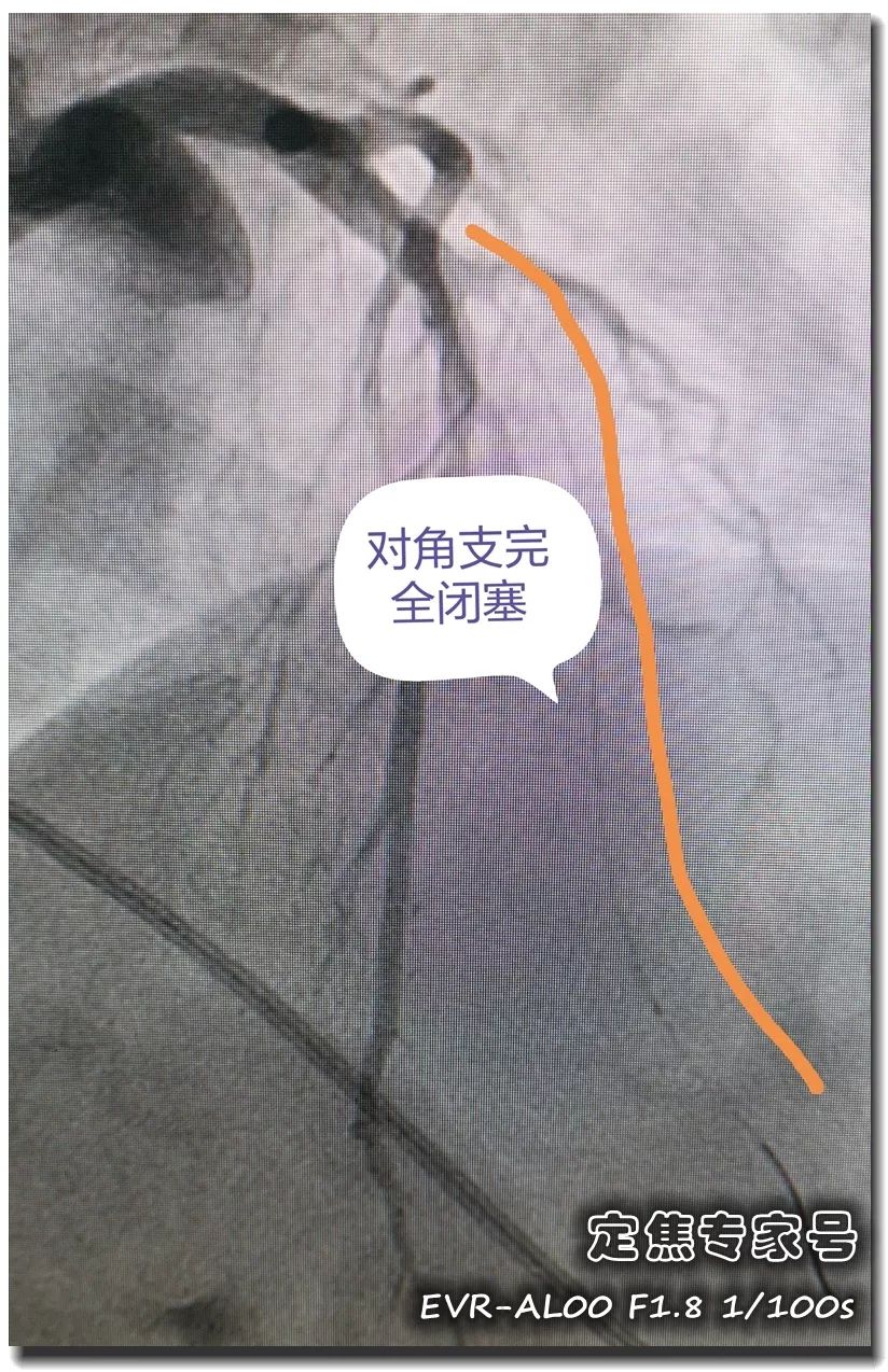 前降支第一对角支图片