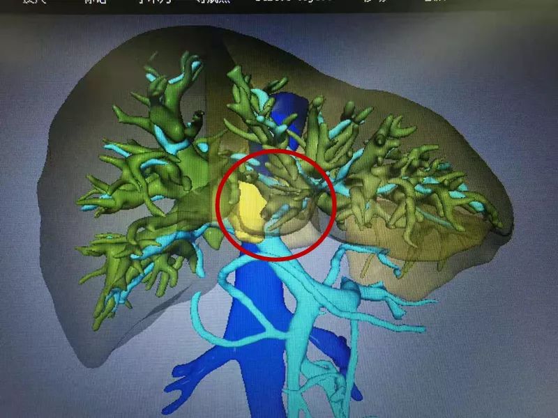 我院成功實施高難度中肝切除治療肝門膽管癌