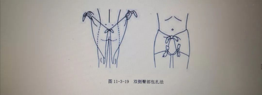 燕尾式三角巾折法图片