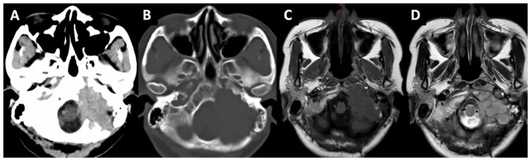 a术前头部ct平扫肿瘤位于左侧岩骨内高密度;b术前岩骨ct见岩骨破坏