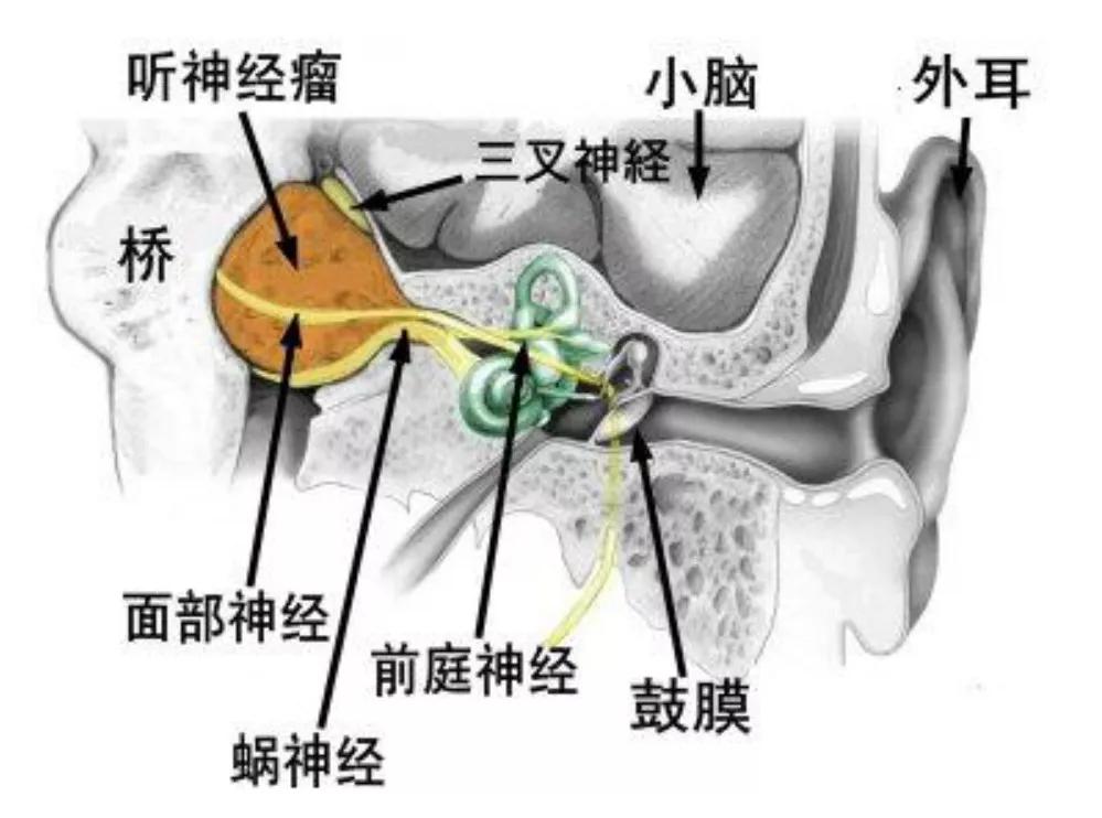 听神经瘤解剖位置图片