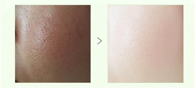 有了这份夏日清爽秘籍,轻松赶走油光和痘印