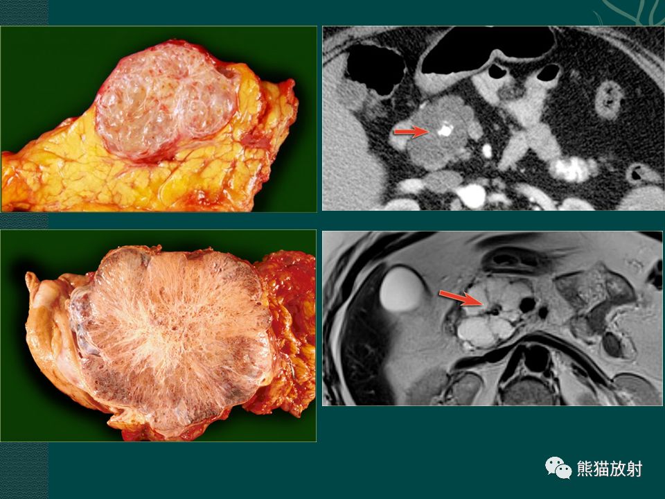 胰腺及脾脏病变丨影像学诊断