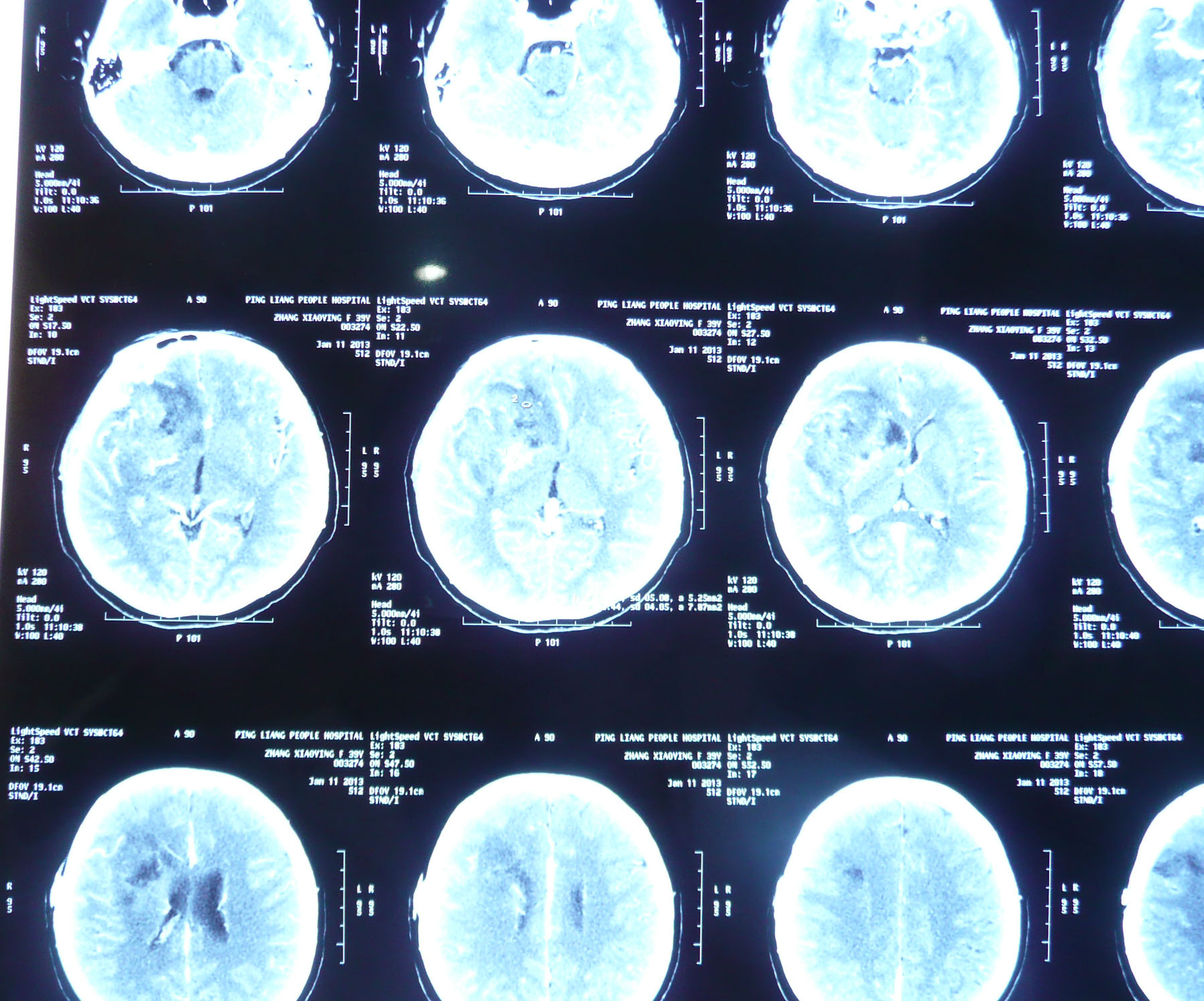 贺晓生教授脑胶质瘤手术案例