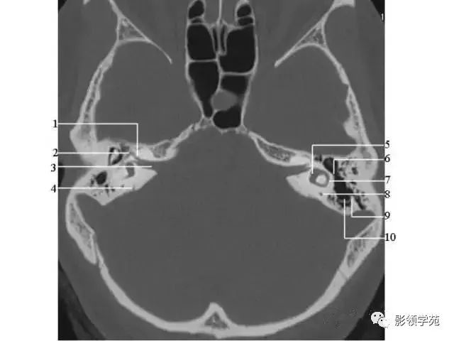 颞骨岩部断层解剖图图片