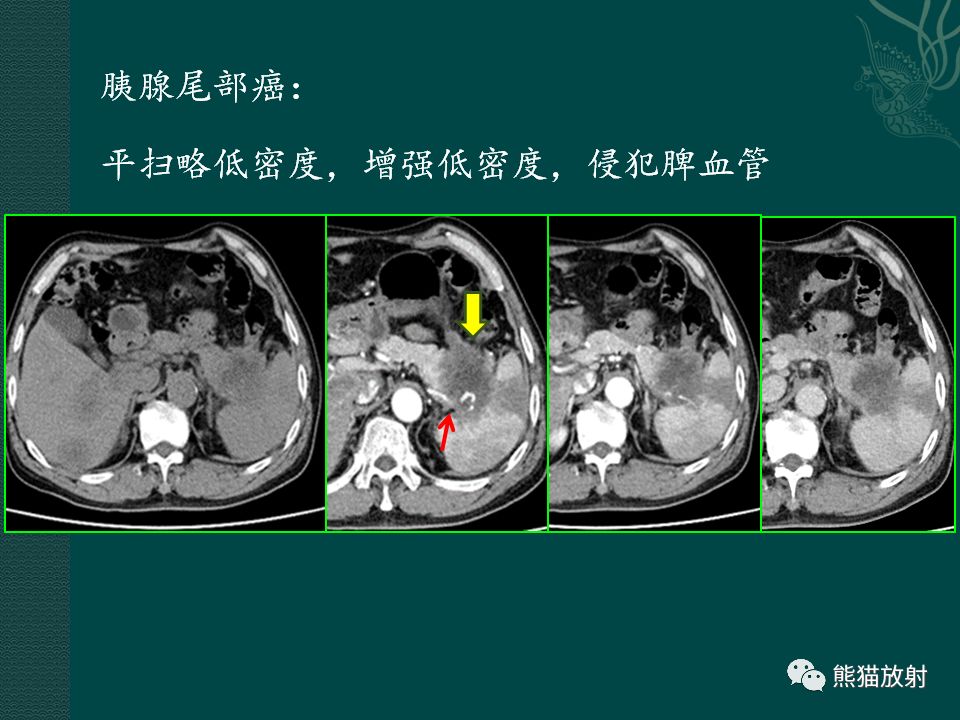 胰腺及脾臟病變丨影像學診斷