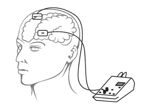 搜狐科学 记忆力差了怎么办?电击大脑可能真的有用