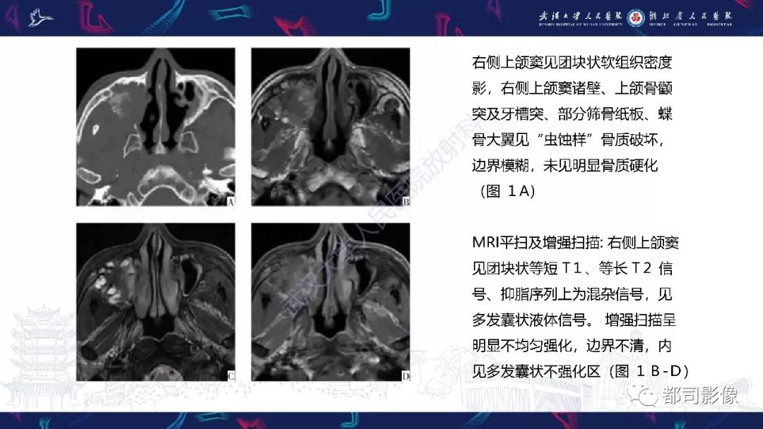 上颌窦癌图片