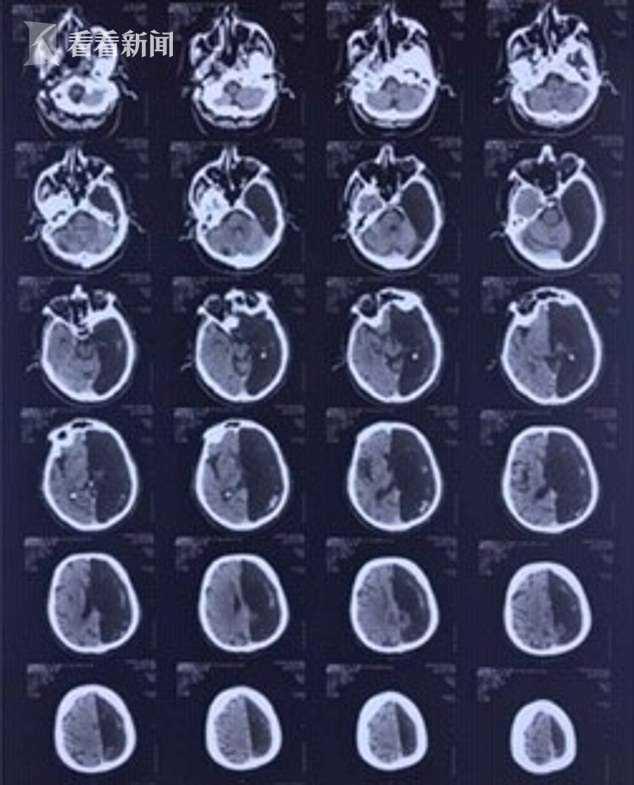 原创神奇60岁老人做头部ct左脑是空的仅靠半个大脑存活