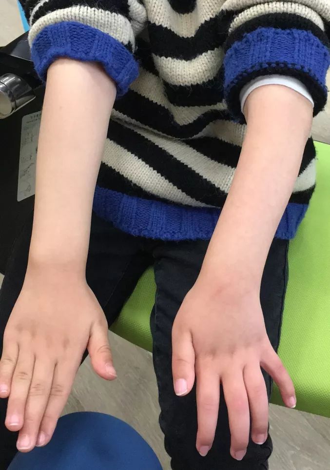 快乐康复帮助6岁关节畸形小女孩重拾舞蹈家的梦想