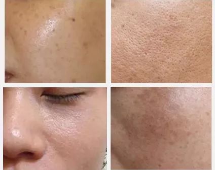 肌肤经常暗沉粗糙,肤色不均匀 √一熬夜就精神不济,长痘暗黄,恢复