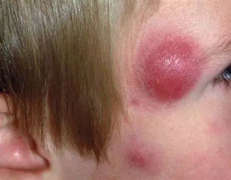 疖和痈是常见的皮肤软组织感染金黄色葡萄球菌可引起皮肤软组织感染