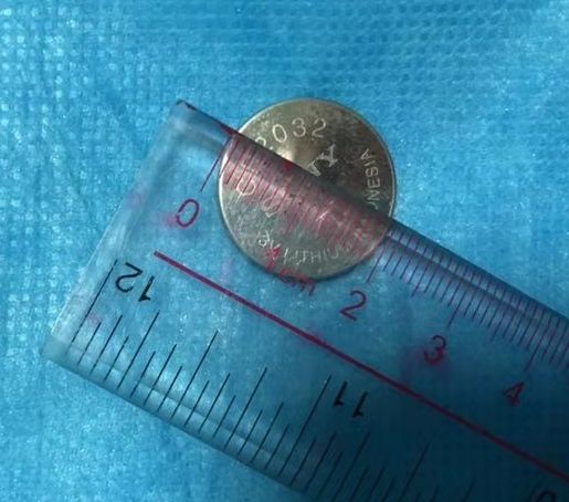 胃镜探查发现,一枚直径大约为2厘米的纽扣样电池在胃腔,胃粘膜已有两