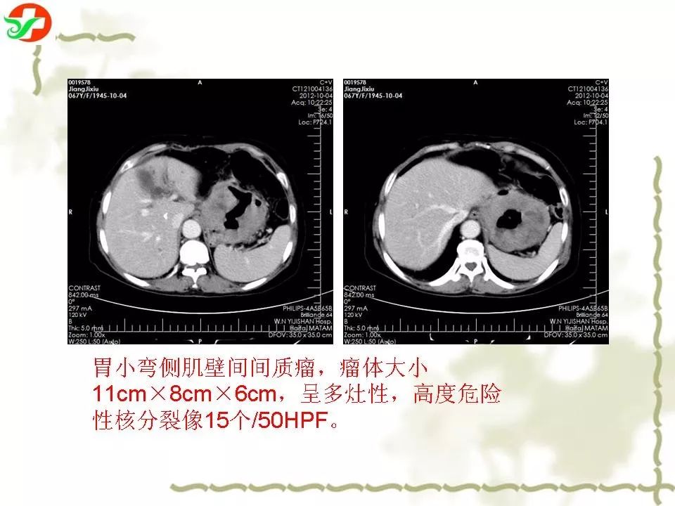 胃腸道間質瘤ctmri診斷影像天地