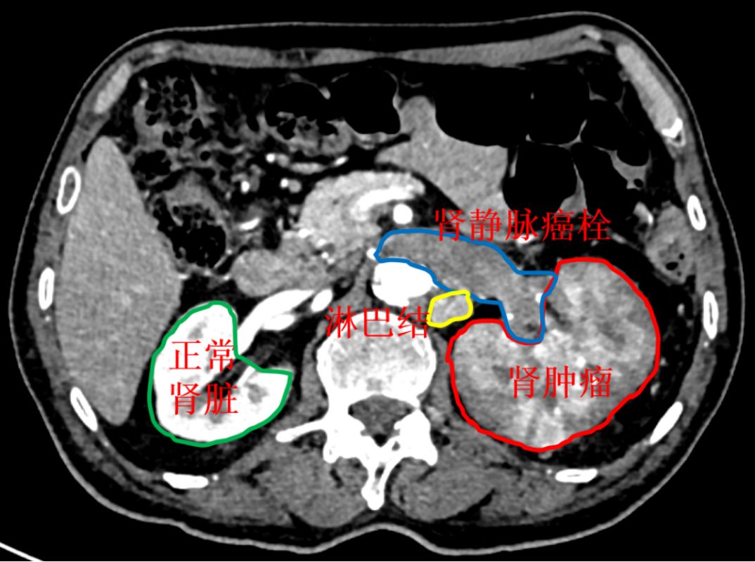 ct提示左肾癌累计输尿管上段,伴肾静脉瘤栓形成,腹膜后淋巴结增大