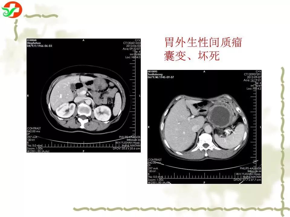 胃腸道間質瘤ctmri診斷影像天地