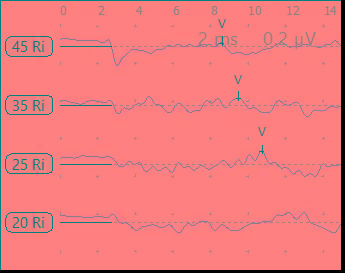 专家点评:该患者的骨导分频率abr与assr均在2000hz存在卡哈切迹,因此