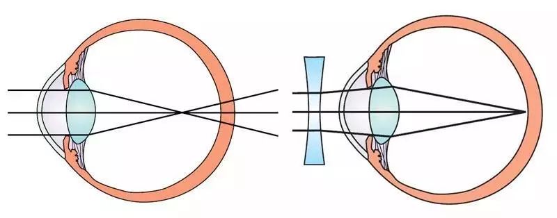 有框架眼镜,隐形眼镜,近视的主要矫