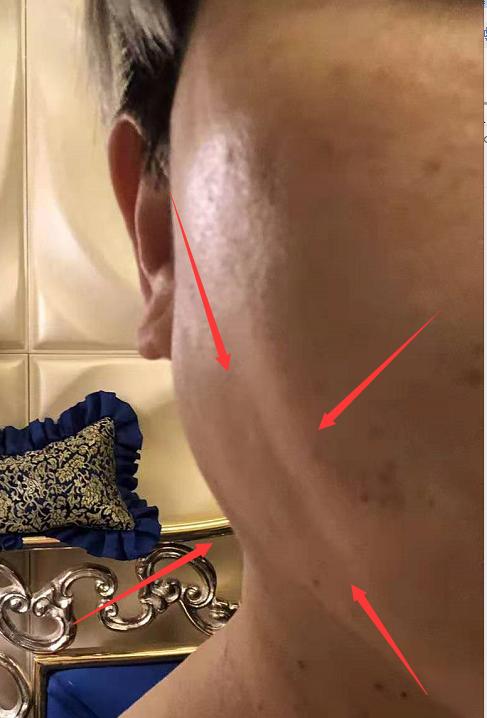 脸部做线雕好吗?知道的聊一聊