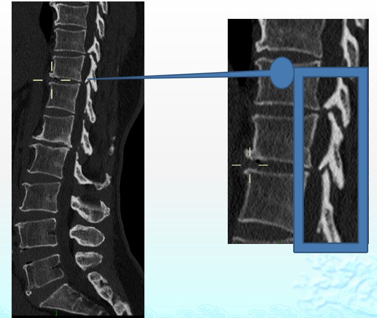 双腿麻木无力走路不稳当心胸椎黄韧带骨化找上你