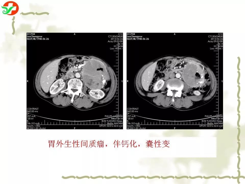 胃肠道间质瘤ctmri诊断影像天地