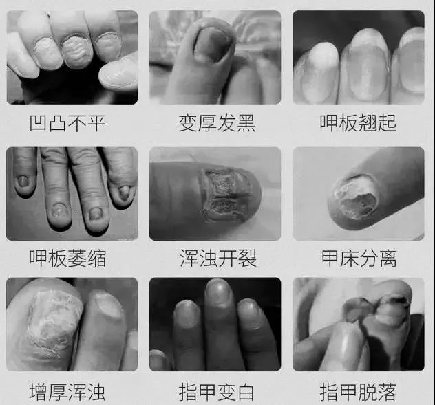 不疼不痒的灰指甲居然危害那么大,你还在无视它吗?