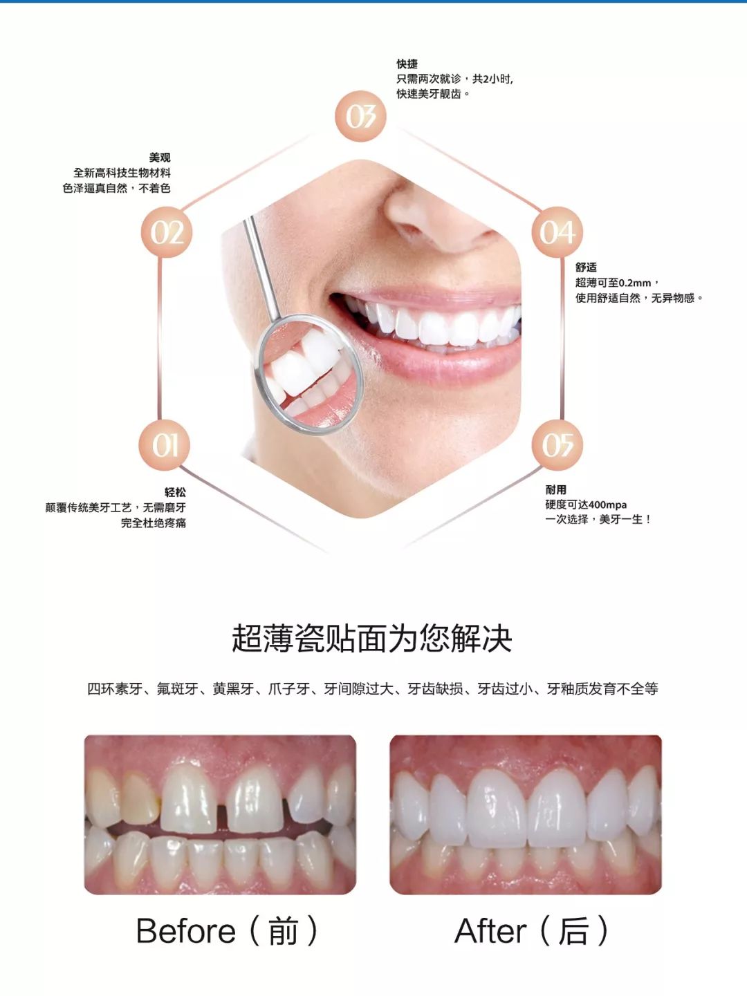 美牙新主張貼面來襲