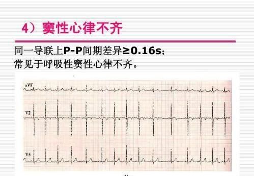 原創一到醫院就做心電圖每次頭提示竇性心律到底是個啥病