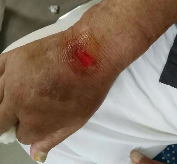 输液贴粘掉3cm2cm的皮肤这起医院性损害转发提醒所有人