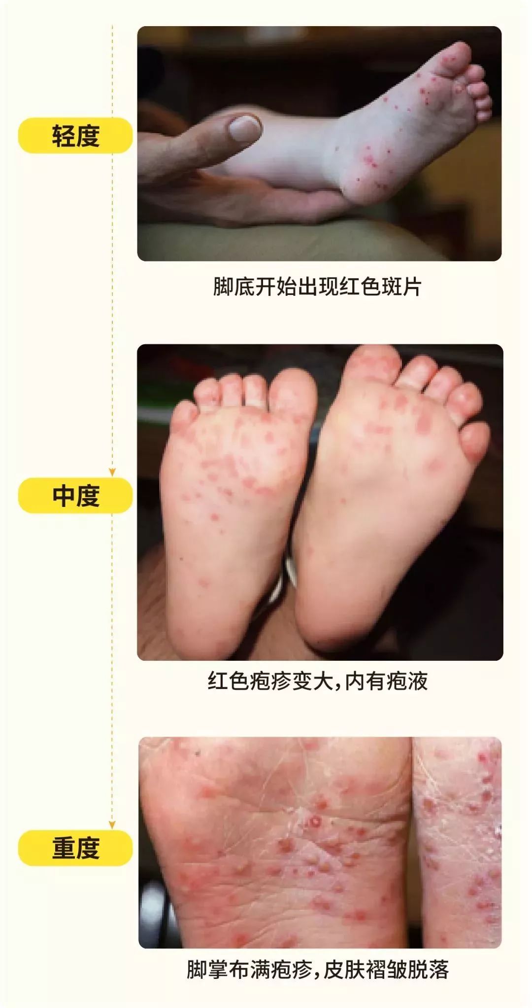 传染病▎手足口病正在高发季