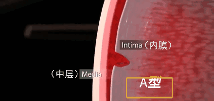 主动脉夹层castor产品的成功上市显著扩大了介入类产品适应证范围