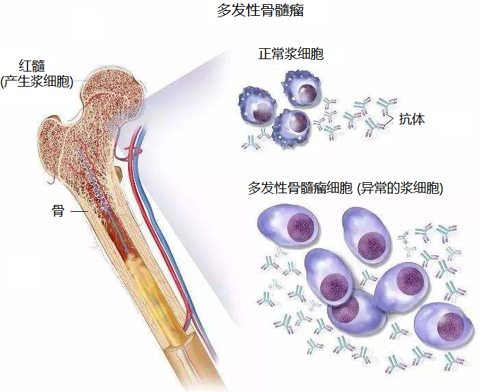 骨髓瘤是起源于骨髓造血组织,浆细胞过度增生所致的恶性肿瘤,由于其