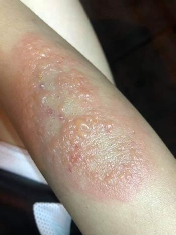 不是蚂蚁却被咬成这样_虫体