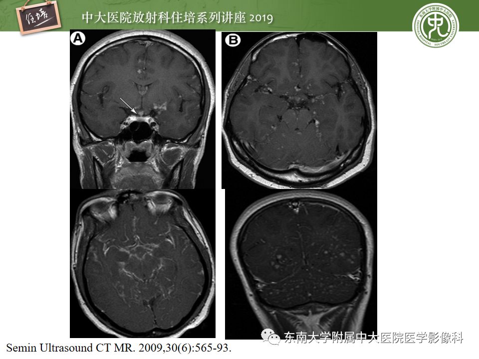 脑膜刺激征三联征图片图片