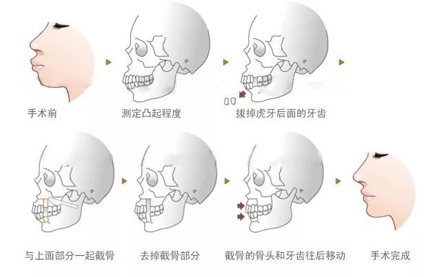 双颌前突手术示意图