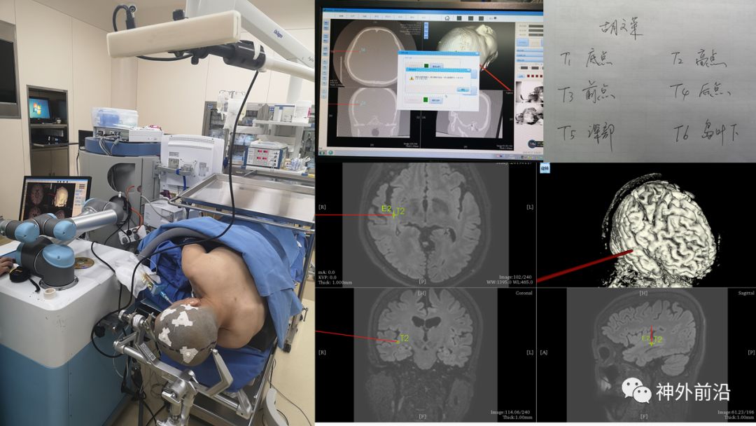 功能神外 天坛医院杨岸超:神经外科手术机器人导航辅助致痫病灶切除