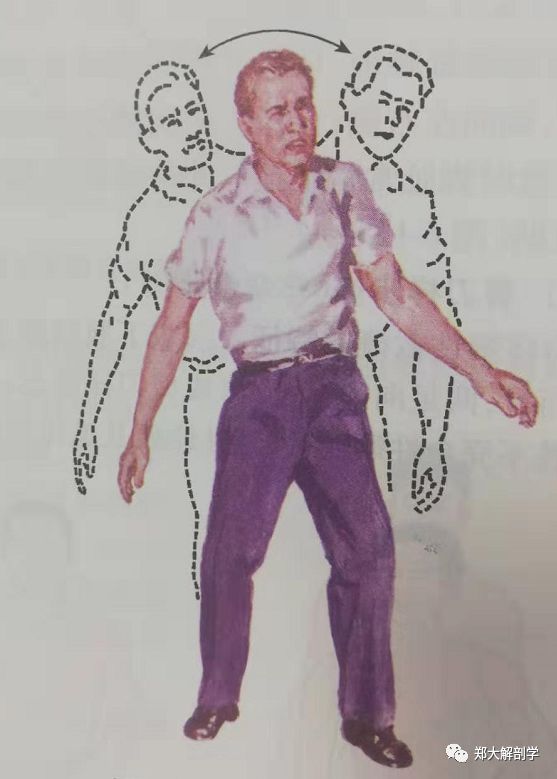 步态分析——临床常见异常步态及常用矫治训练方法_患者