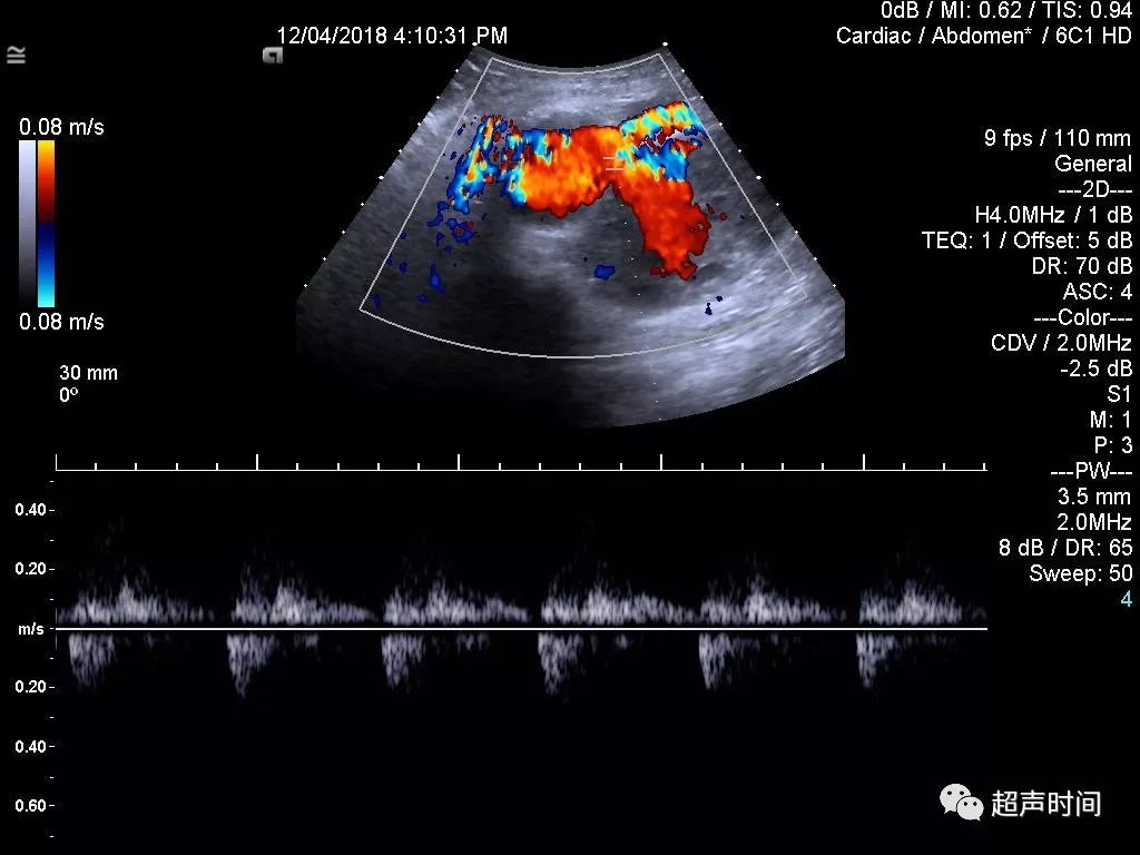 假性动脉瘤超声图片