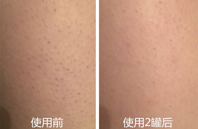 鸡皮肤能涂防晒吗(鸡皮肤能涂防晒吗女)